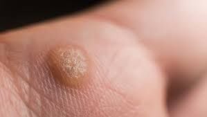 Verruca on the sole of a foot